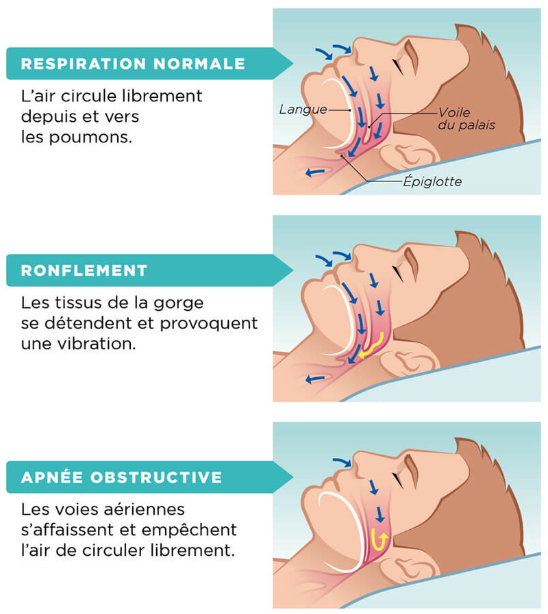 Apnées du sommeil : Trouver un soulagement naturel grâce à la naturopathie Apnées du sommeil : Trouver un soulagement naturel grâce à la naturopathie