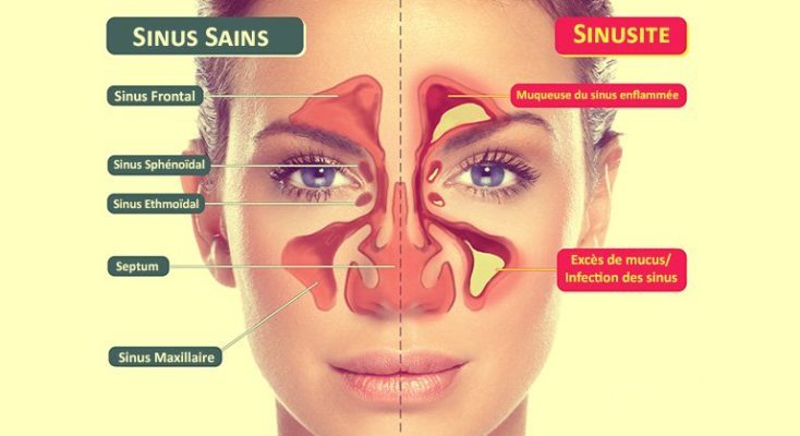 Traiter la Sinusite avec des Huiles essentielles Traiter la Sinusite avec des Huiles essentielles