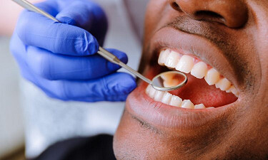 Comment le diabète affecte-t-il ta santé bucco dentaire ? Comment le diabète affecte-t-il ta santé bucco dentaire ?