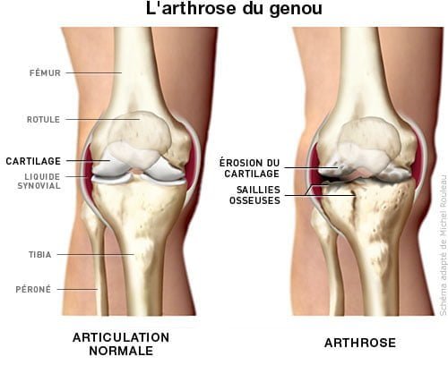Vaincre l'Arthrose avec la Médecine Naturelle et l'Alimentation 🌿💪 - A Lire si vous souffrez !
