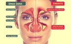 Traiter la Sinusite avec des Huiles essentielles Traiter la Sinusite avec des Huiles essentielles
